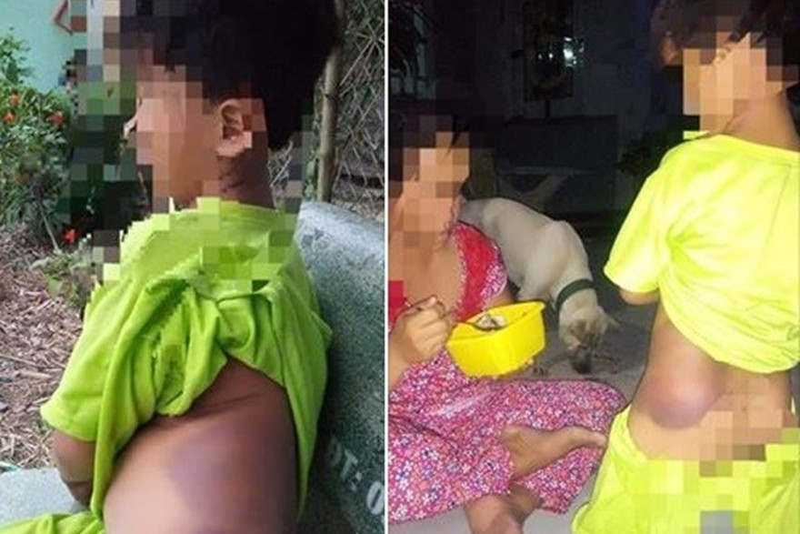 Vết thương trên cơ thể K nghi do cô giáo đánh