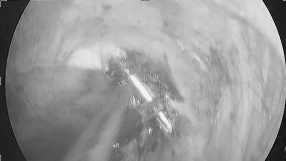 Không theo chỉ định bác sĩ, bệnh nhân bị đinh xuyên phổi vào tủy sống