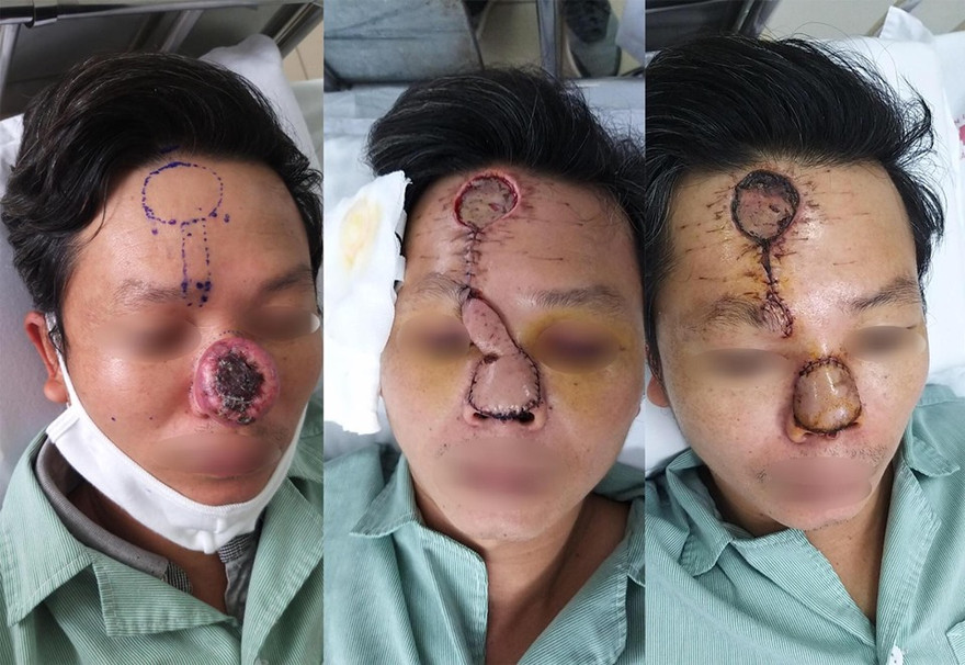 Kỳ diệu tái tạo mũi cho bệnh nhân ung thư bị xâm lấn đường thở