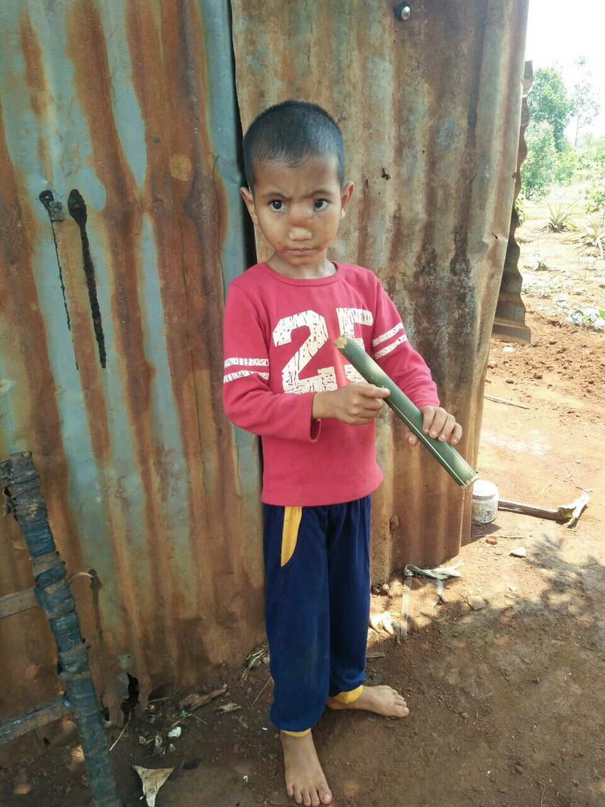 Kỳ lạ trẻ có não thoát xuống mũi