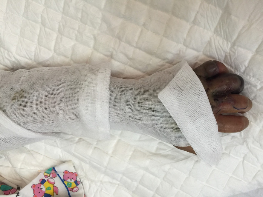 Bị rắn cắn, bé 10 tuổi hoại tử nặng vì đắp lá thuốc