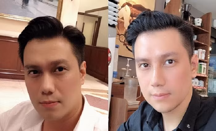 Vì sao Việt Anh vội vàng phẫu thuật thẩm mỹ ngay sau khi ly hôn?
