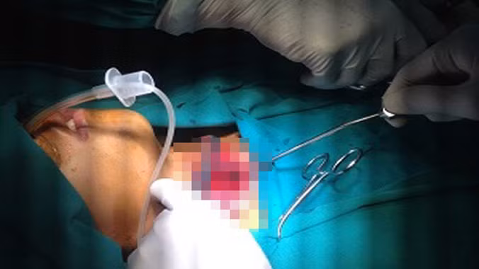 Các bác sĩ thực hiện ca ghép nối khí quản cho bệnh nhi Đức. Ảnh: Bệnh viện cung cấp.