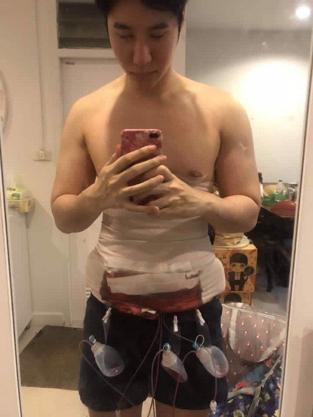 Thời gian hồi phục màn "tạc cơ bụng" là khoảng 3-6 tuần.