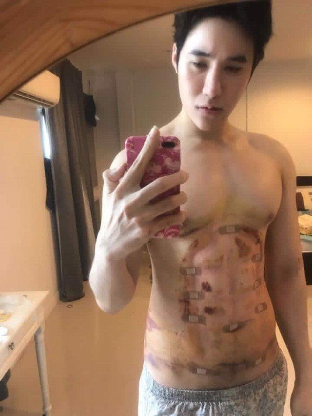 Phương pháp này được xem gần giống với kiểu hút mỡ.