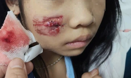 Cháu bé bị khỉ hoang tấn công khi chơi ở sân nhà