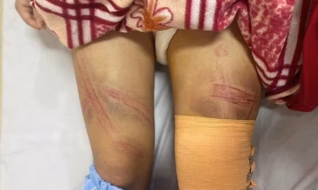 Nữ sinh lớp 7 ở Nghệ An nhập viện nghi do bị bố bạo hành