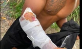 Nam thanh niên bị cá sấu tấn công thương tích.