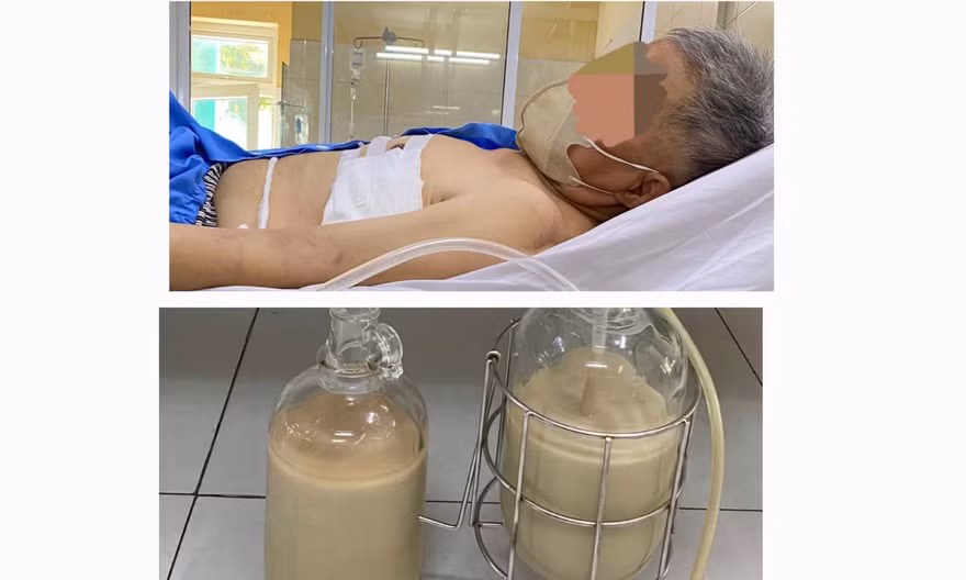 Hút ra hàng lít mủ từ phổi người đàn ông ở Đà Nẵng
