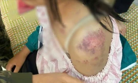 Bé gái 13 tuổi bị bà nội và hai người ông tra khảo, đánh đập dã man vì nghi trộm tiền 