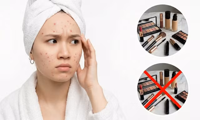 Trang điểm khi trị mụn: Nên hay không? Lời khuyên từ chuyên gia
