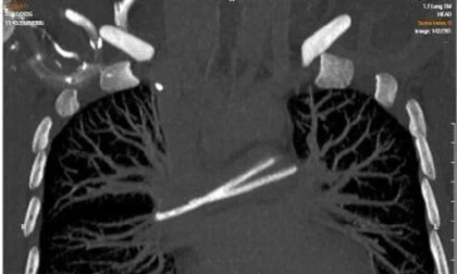 Ống truyền hóa chất trôi vào tim, bị 'bỏ quên' nhiều năm trong cơ thể