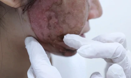 Dồn dập tai biến cao điểm làm đẹp “cấp tốc” mùa Tết