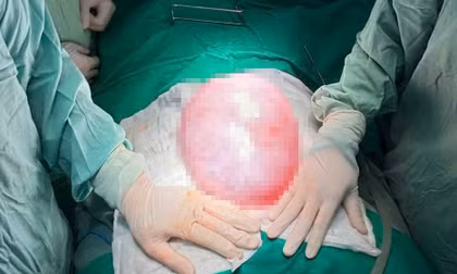 Phát hiện khối u gần 4kg trong bụng bé gái 13 tuổi 