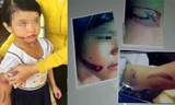 vết thương trên tay bé T. nghi bị bạo hành