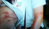 Vết thương của 2 cháu bé sau những trận đòn roi của bố. Ảnh: Gia đình cung cấp