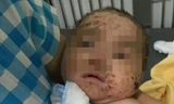 Sau 5 ngày được chăm sóc, tổn thương của trẻ đã khô và bong vảy