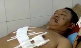 Sơn bị thương ở phần bụng và ngực đang được điều trị tại bệnh viện đa khoa thị xã Sơn Tây