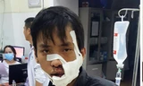 Thanh niên tên Phát bị nhóm đối phương phản đòn, chém vào mặt