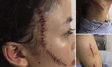 Lộ nguyên nhân cô gái 18 tuổi bị bạn dùng dao rạch mặt phải khâu hàng chục mũi