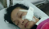 Nữ sinh Lan Anh bị đâm rách vùng mặt, kéo dài từ toàn bộ phần má đến mang tai