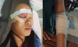 Chị Tuyết với vết thương ở vùng mặt và cánh tay bị gãy của bà Thủy