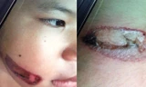 Vết bỏng trên người bé T