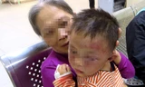 Khuôn mặt cháu H. bị thâm tím trông rất đau lòng