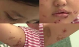 Những vết thương dày đặc trên cơ thể bé gái 6 tuổi