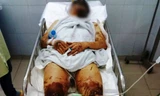 Một vụ tạt axit, hủy hoại thân thể gây rúng động Quảng Ngãi