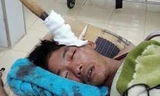 Nạn nhân bị bạn cùng phòng đâm dao vào đầu