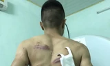 Anh Hưng với vết thương trên lưng