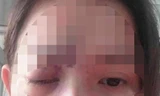  Thiếu nữ mù mắt, nhập viện cấp cứu vì tiêm filler thẩm mỹ ở tiệm cắt tóc, gội đầu