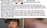 Em Đ bị đánh bầm tím đùi