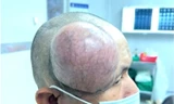 Phẫu thuật thành công khối u to như cái chén ở đầu bệnh nhân