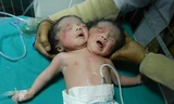Bé sơ sinh hai đầu chào đời tại Bangladest