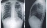 Tìm ra nguyên nhân vì sao nhiều người không bao giờ hút thuốc lá lại bị ung thư phổi