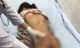 Điều tra vụ bé gái bị chi chít vết thương khi ở với cô họ