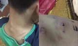 Những vết thương trên người cháu N. Ảnh: Thanh Hà.