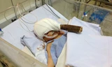 Bé sơ sinh 11 ngày tuổi nhập viện với lưỡi dao cắm sâu trong đầu. Ảnh do bệnh viện cung cấp.