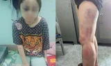 Nạn nhân bị hành hung nhiều bộ phận như mặt, chân, lưng