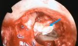 Bé gái suýt bị điếc vì khối cholesteatoma ăn mòn xương con trong tai giữa