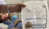 'Quên' ống sonde trong cơ thể suốt 9 năm, cụ bà bị sỏi bám to bằng quả trứng