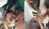 Căng não bác sĩ cứu bé trai ngưng tim ngưng thở vì hóc thạch rau câu
