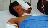 Vết bỏng nặng trên mặt, tay của Thái. Ảnh: Nguyễn Huy