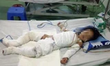 Cháu bị bỏng nặng vì dì dùng xăng nhóm bếp