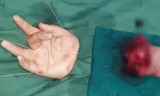 Nối thành công bàn tay bị chém đứt lìa của cậu bé 12 tuổi 