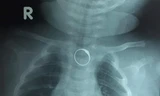 Chiếc nhẫn vàng kẹt ở thực quản bé gái 2 tháng tuổi
