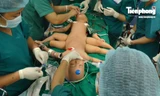 CLIP: Bên trong phòng mổ tách cặp song sinh dính nhau ở TPHCM