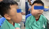 Bé trai bị khối u chiếm trọn khuôn mặt bên phải.